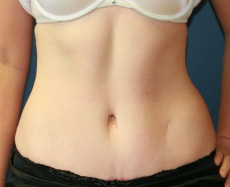 Tummy Tuck San Diego 66 - after - front