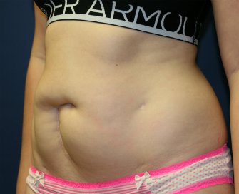 Tummy Tuck San Diego 66 - before - oblique