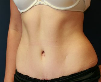 Tummy Tuck San Diego 66 - after - oblique