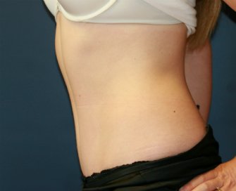 Tummy Tuck San Diego 66 - after - side