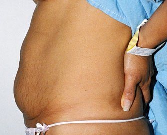 Tummy Tuck Case 5 - before - side