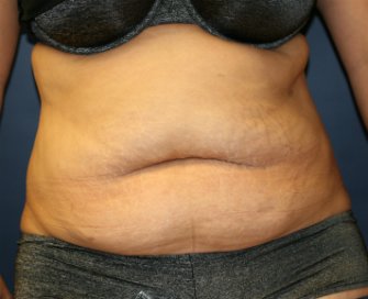 Tummy Tuck San Diego 67 - before - front