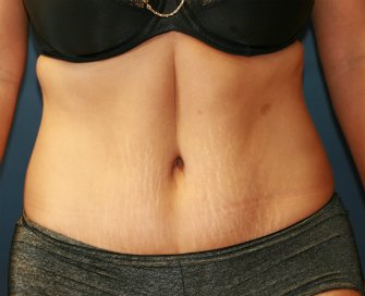 Tummy Tuck San Diego 67 - after - front