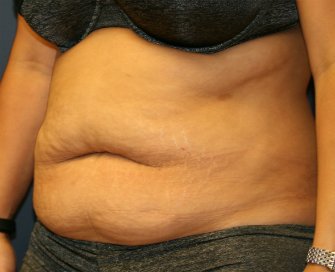 Tummy Tuck San Diego 67 - before - oblique