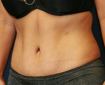 Tummy Tuck San Diego 67 - after - oblique