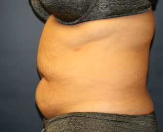 Tummy Tuck San Diego 67 - before - side