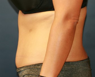 Tummy Tuck San Diego 67 - after - side