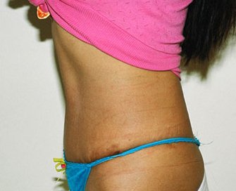 Tummy Tuck Case 5 - after - side