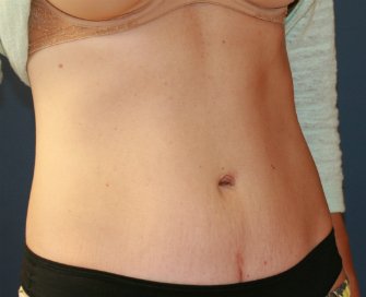 Tummy Tuck San Diego 68 - after - oblique