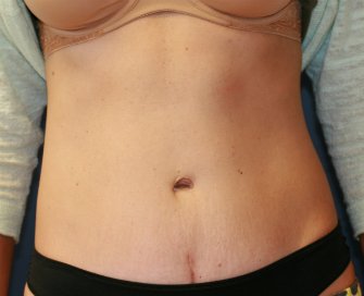 Tummy Tuck San Diego 68 - after - side