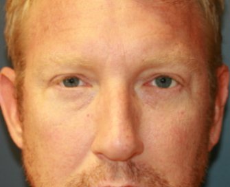 Eyelid-rejuvenation-80 - after - front