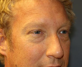 Eyelid-rejuvenation-80 - before - right oblique