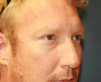 Eyelid-rejuvenation-80 - after - right oblique