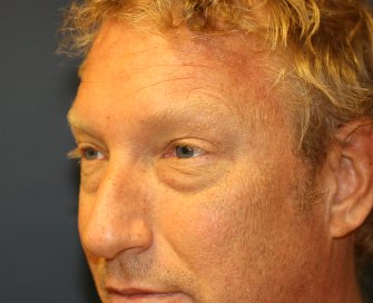 Eyelid-rejuvenation-80 - before - left oblique