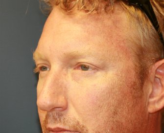 Eyelid-rejuvenation-80 - after - left oblique
