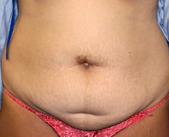 Tummy Tuck Case 20 - before - front