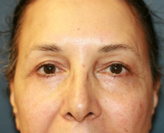 Eyelid-rejuvenation-81 - after - front