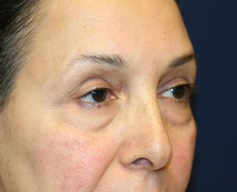 Eyelid-rejuvenation-81 - before - right oblique