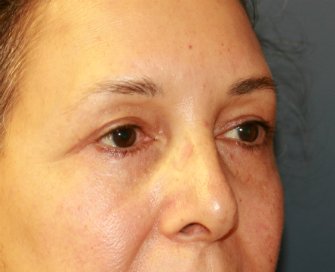 Eyelid-rejuvenation-81 - after - right oblique
