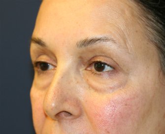 Eyelid-rejuvenation-81 - before - left oblique