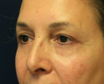Eyelid-rejuvenation-81 - after - left oblique