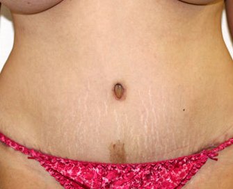 Tummy Tuck Case 20 - after - front