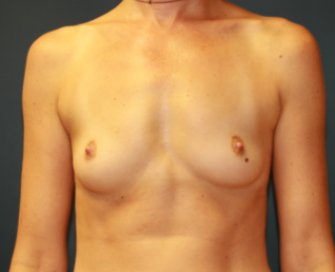 Breast-Augmentation-104 - before - front