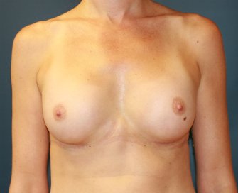 Breast-Augmentation-104 - after - front