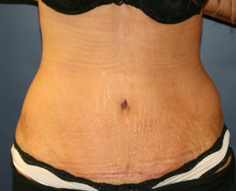 Tummy Tuck San Diego 70 - after - front