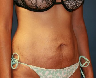 Tummy Tuck San Diego 70 - before - oblique