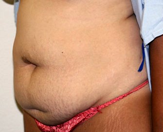 Tummy Tuck Case 20 - before - angle