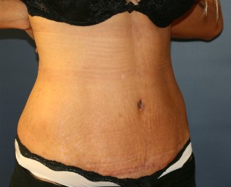 Tummy Tuck San Diego 70 - after - oblique
