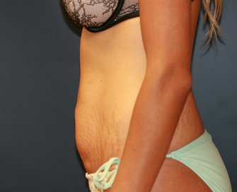 Tummy Tuck San Diego 70 - before - side