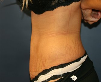 Tummy Tuck San Diego 70 - after - side