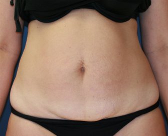 Tummy Tuck San Diego 71 - before - front