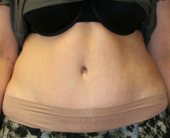 Tummy Tuck San Diego 71 - after - front