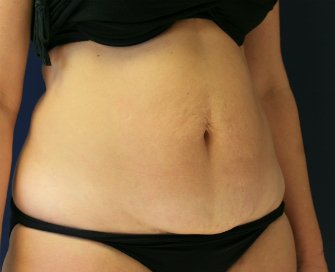 Tummy Tuck San Diego 71 - before - oblique