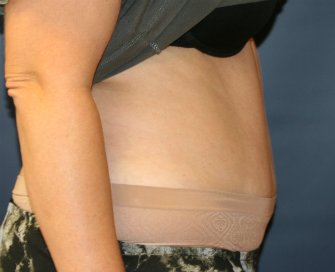Tummy Tuck San Diego 71 - after - side