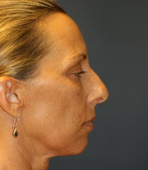 Rhinoplasty (nose re-shaping) 48 - before - front