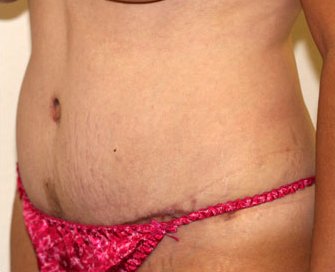Tummy Tuck Case 20 - after - angle