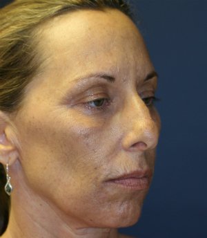 Rhinoplasty (nose re-shaping) 48 - before - oblique