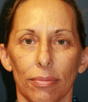 Rhinoplasty (nose re-shaping) 48 - before - side