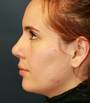 Rhinoplasty (nose re-shaping) 49 - after - front