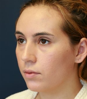 Rhinoplasty (nose re-shaping) 49 - before - oblique