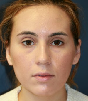 Rhinoplasty (nose re-shaping) 49 - before - side