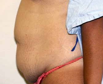 Tummy Tuck Case 20 - before - side