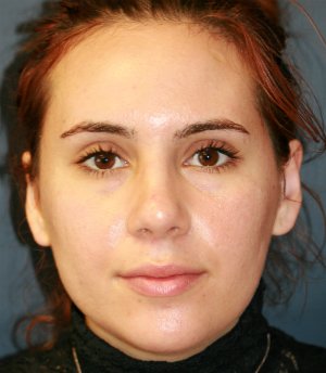 Rhinoplasty (nose re-shaping) 49 - after - side