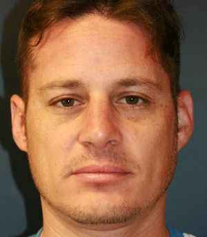 Rhinoplasty (nose re-shaping) 50 - after - front