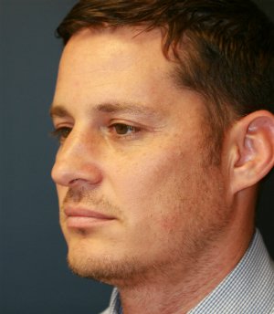 Rhinoplasty (nose re-shaping) 50 - before - oblique