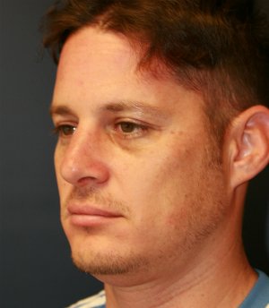 Rhinoplasty (nose re-shaping) 50 - after - oblique